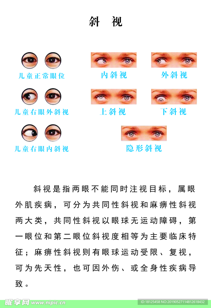 斜视