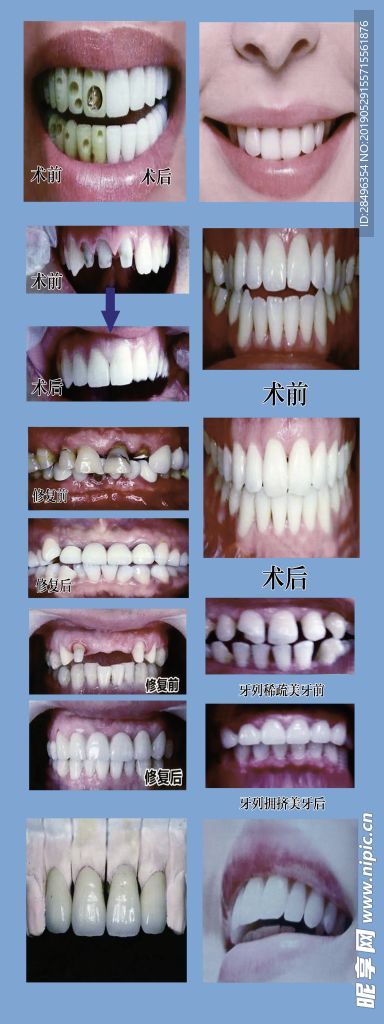 牙齿 修复 牙冠  美白 丽齿