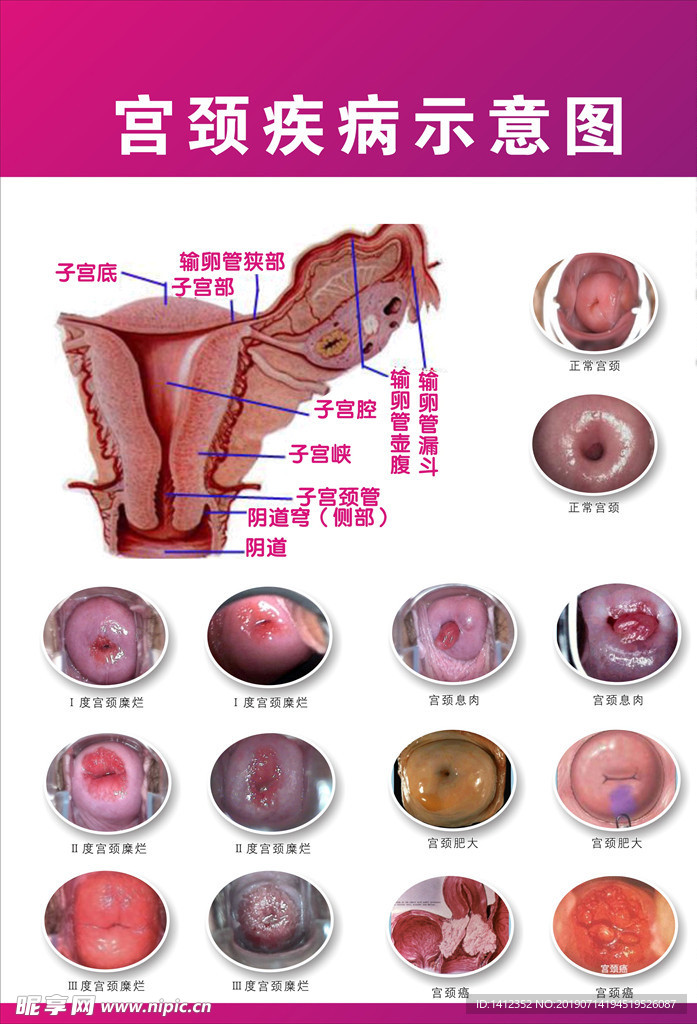 宫颈疾病示意图