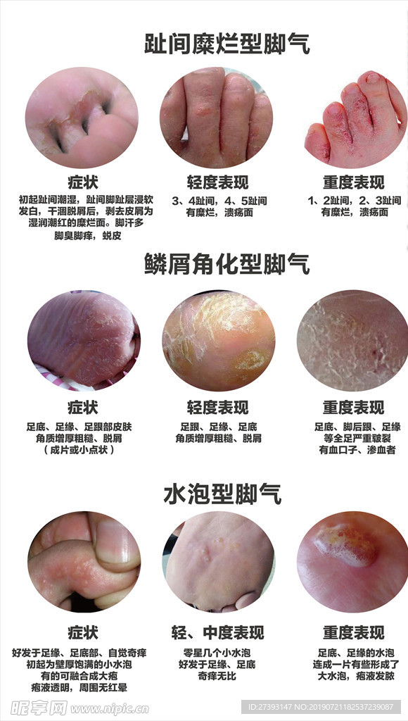 脚气种类