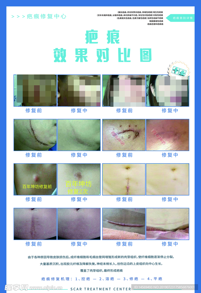 疤痕对比图