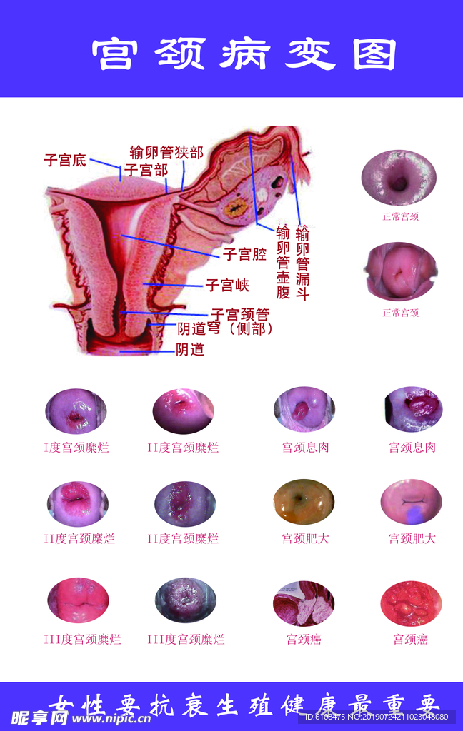 宫颈癌变图