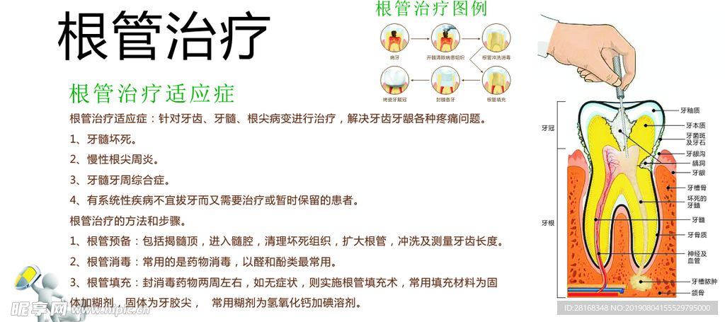 根管治疗