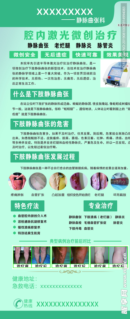 静脉曲张展架