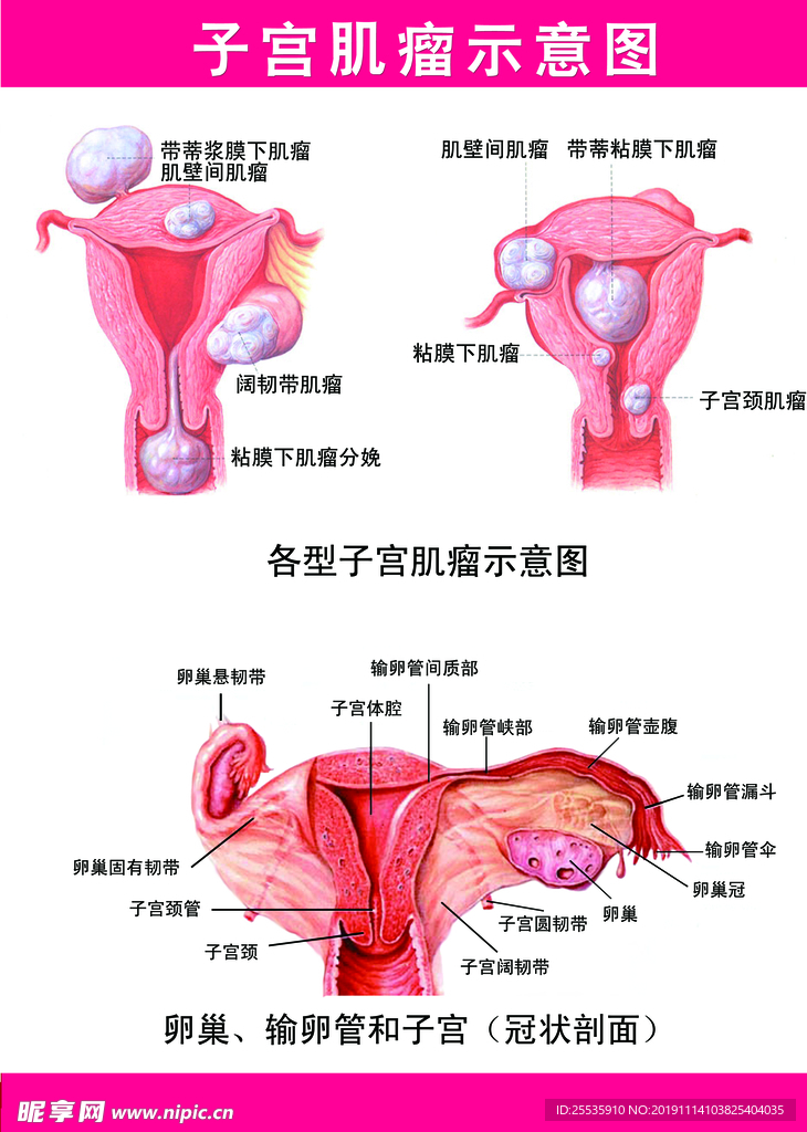 子宫肌瘤挂图