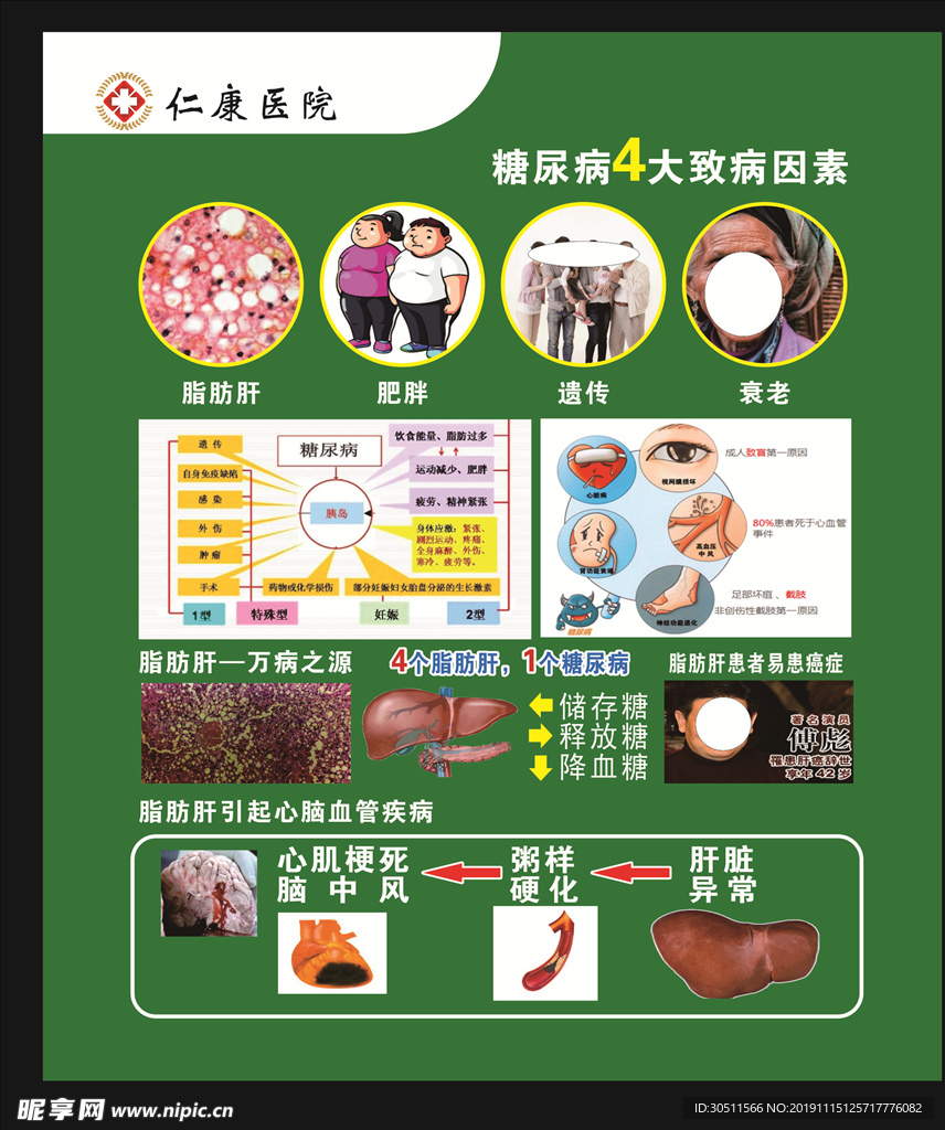 糖尿病致病因素展板