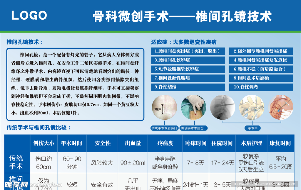 椎间孔镜技术