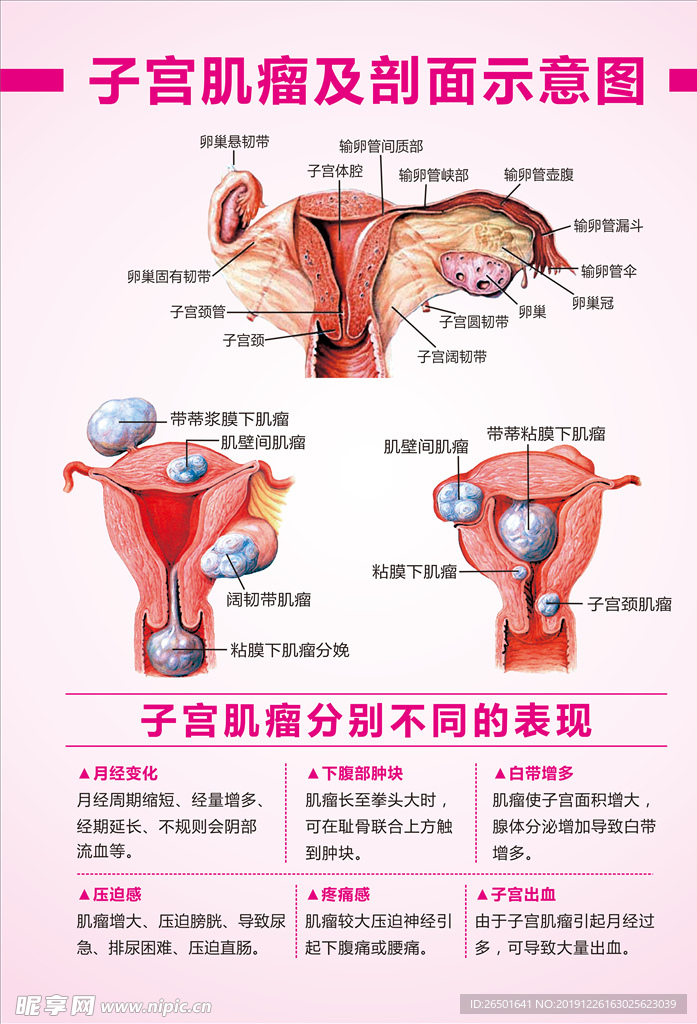 子宫肌瘤示意图 子宫肌瘤表现