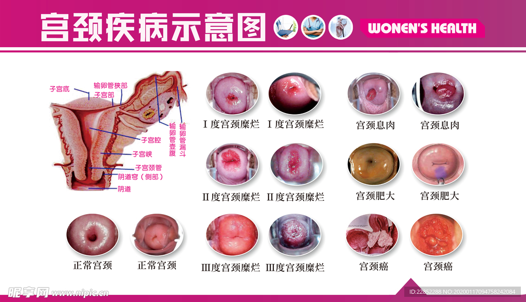 宫颈疾病 可防可治