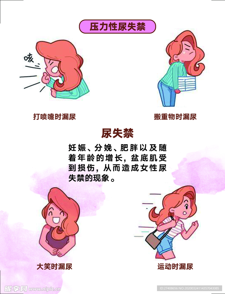 压力性尿失禁