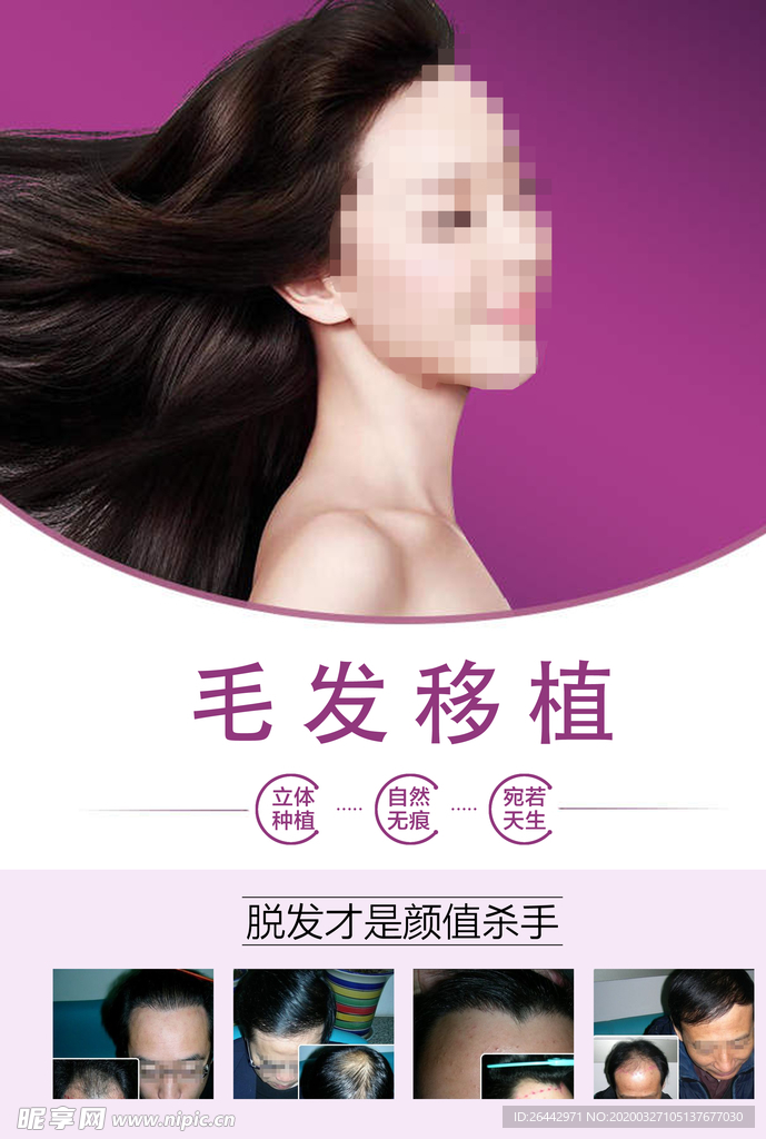 毛发移植