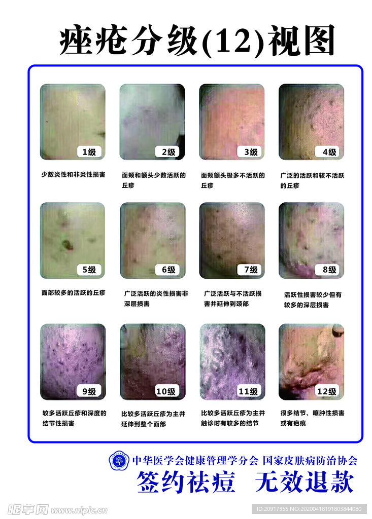 痤疮分级图 痤疮12视图