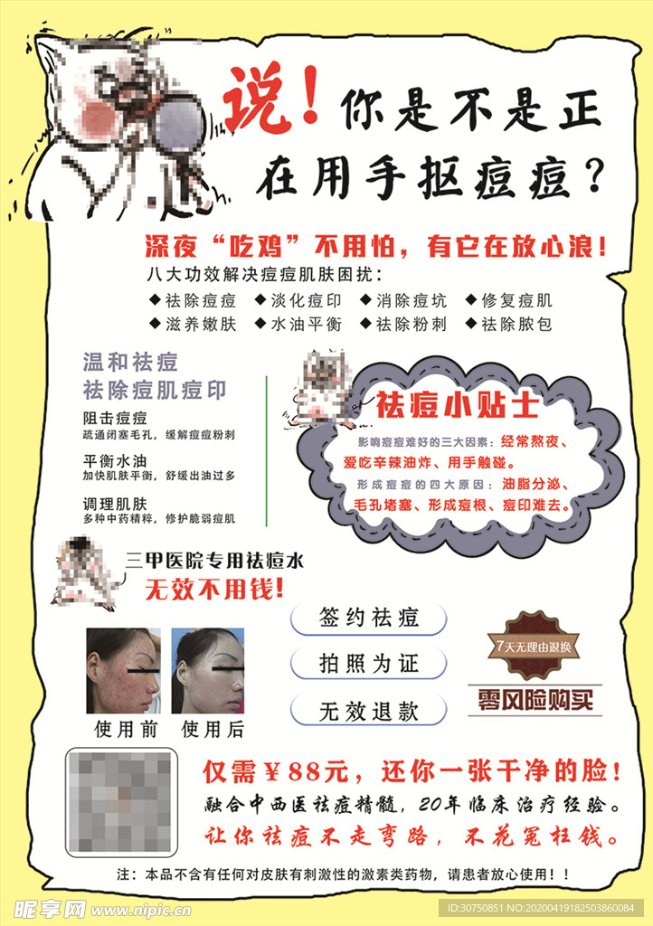 祛痘宣传单