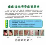痤疮介绍