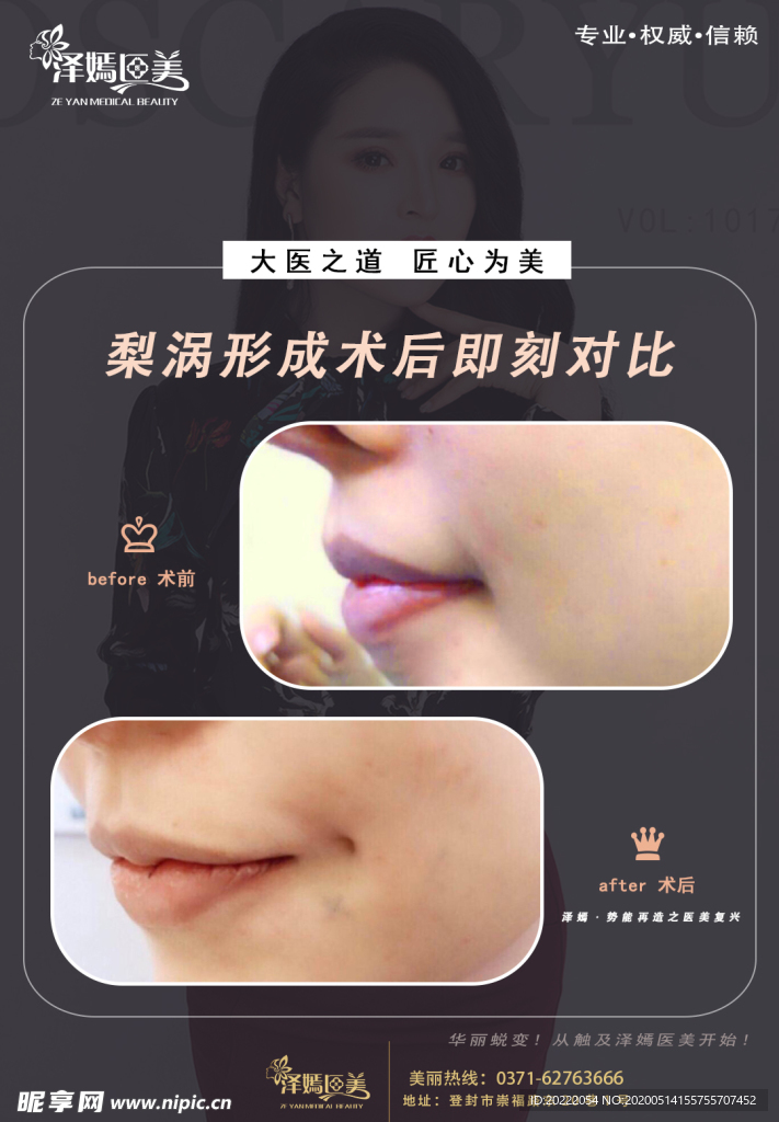 医美 整形 美容 梨涡