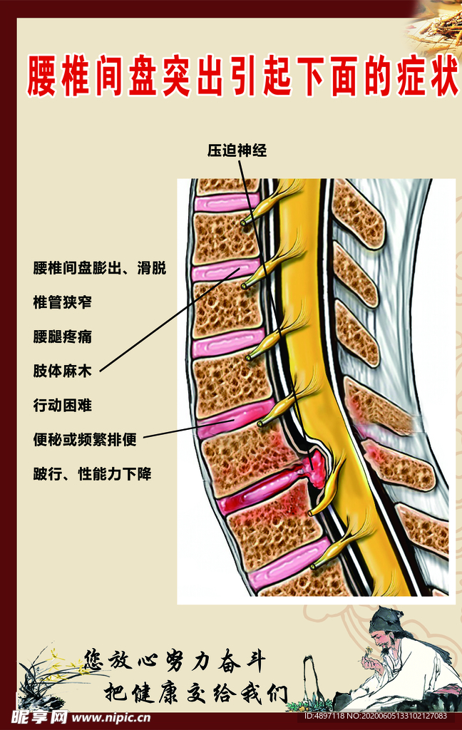 腰间盘突出