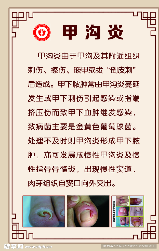 甲沟炎