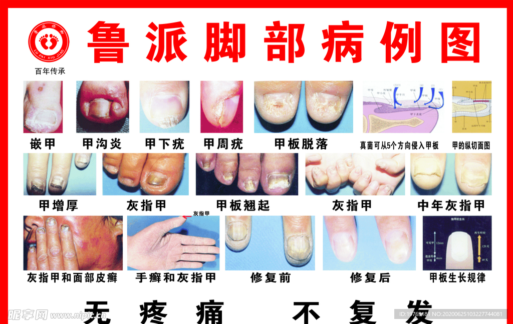 脚部病例图