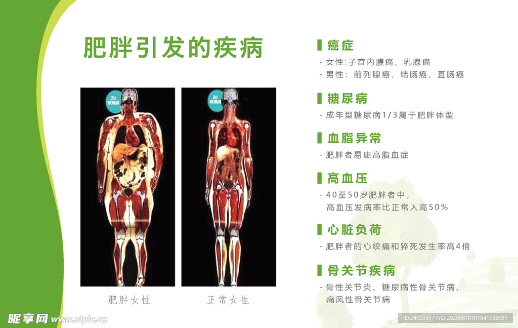 肥胖引起的疾病