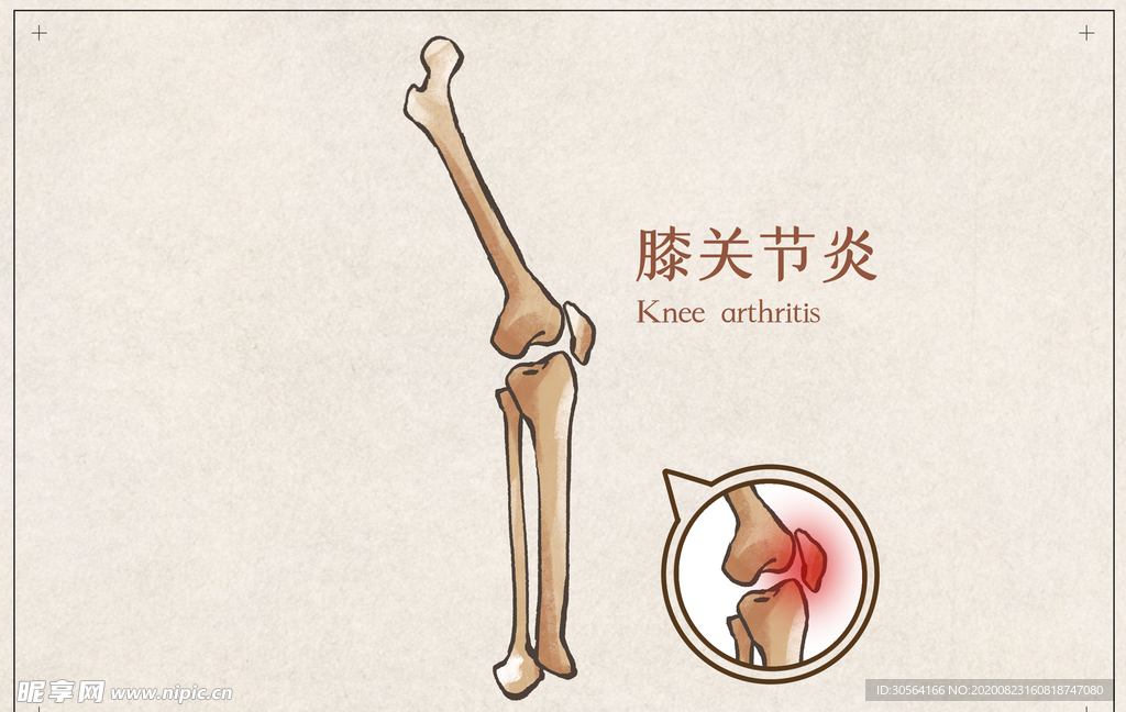 膝关节炎骨骼宣传展板素材