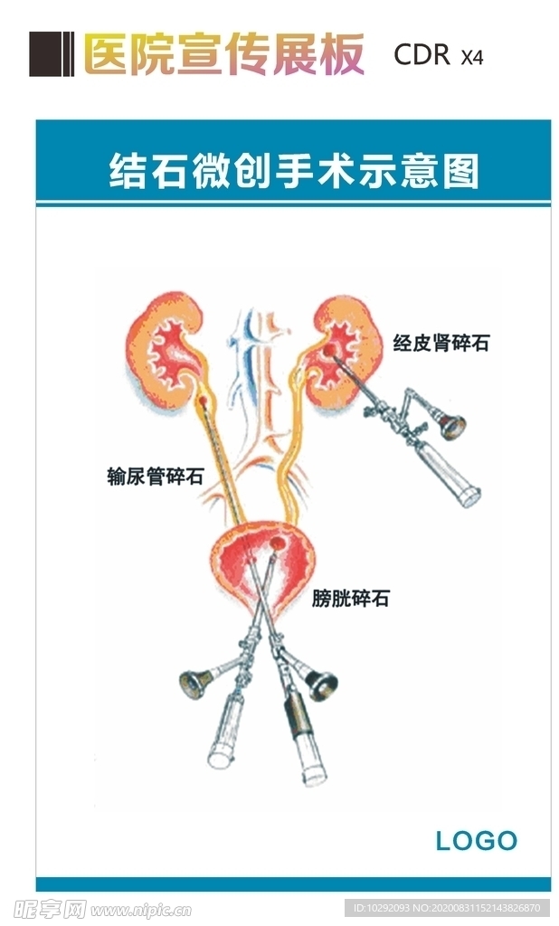 结石手术示意图