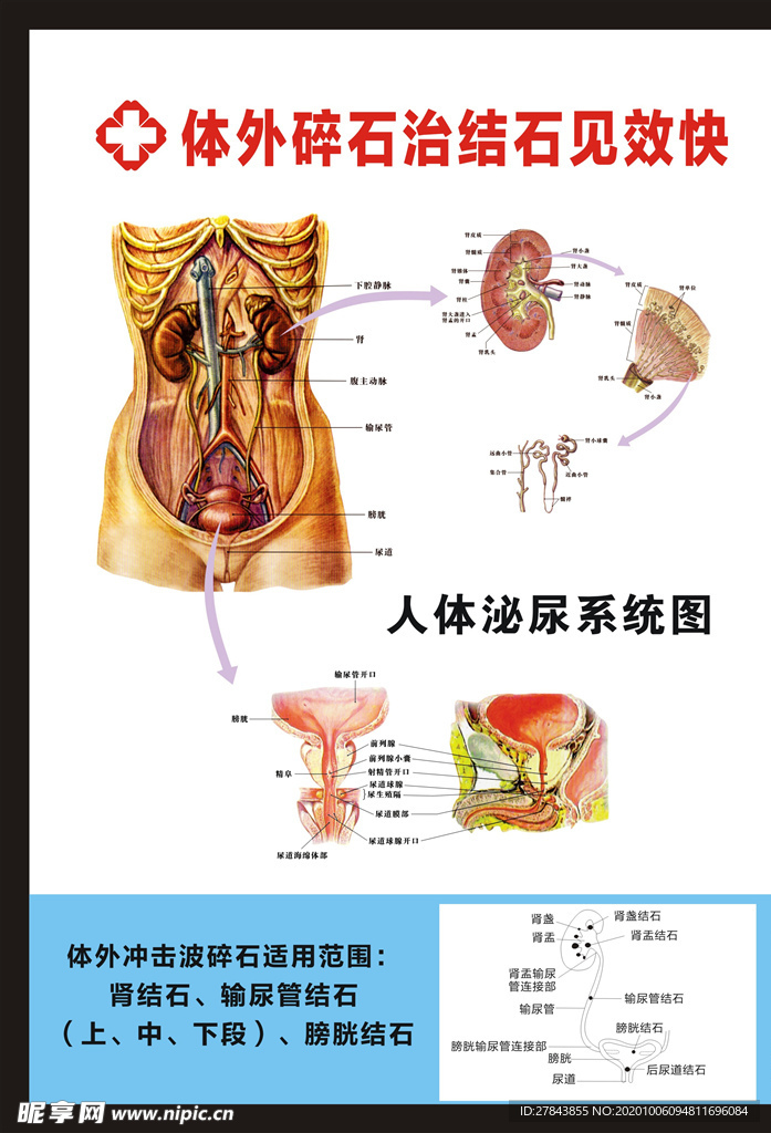 体外碎石