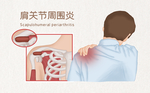 肩周炎疾病养生背景海报素材