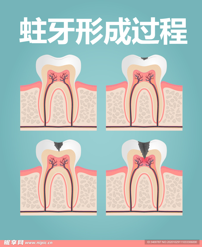 蛀牙的形成过程