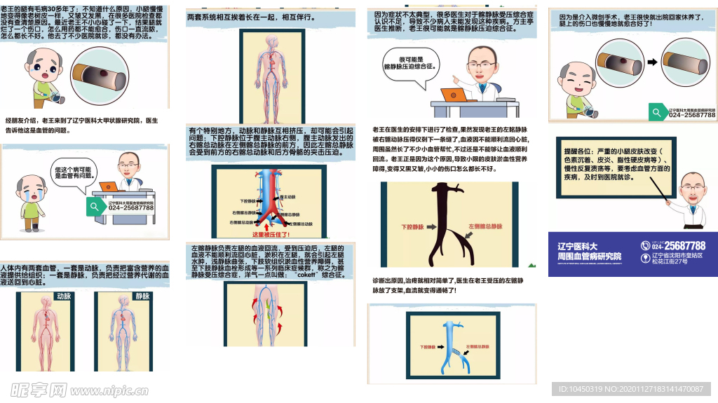 静脉曲张