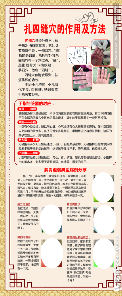 中医扎四缝