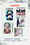 毛囊种植