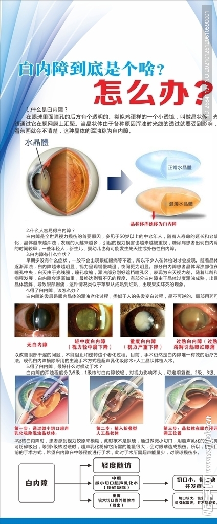 白内障门型