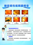 糖尿病性视网膜病变