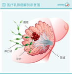 医疗乳腺癌乳腺增生示意图