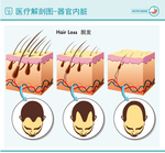 医疗脱发解剖图