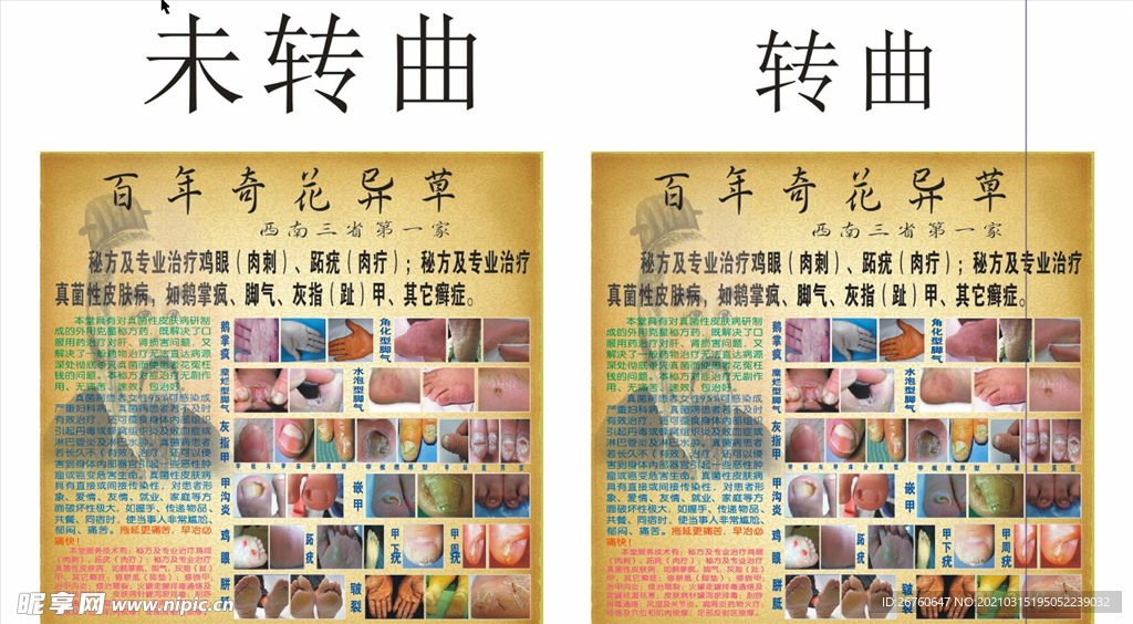 灰指甲