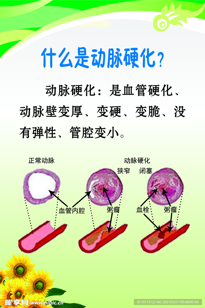 什么是动脉硬化