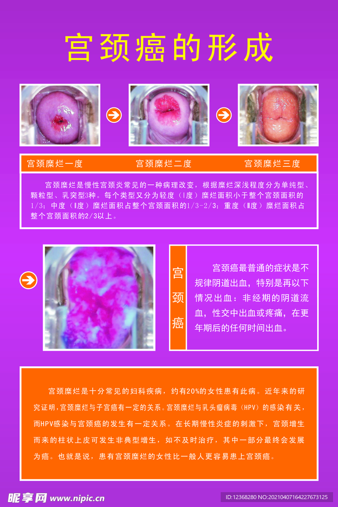 宫颈癌的形成