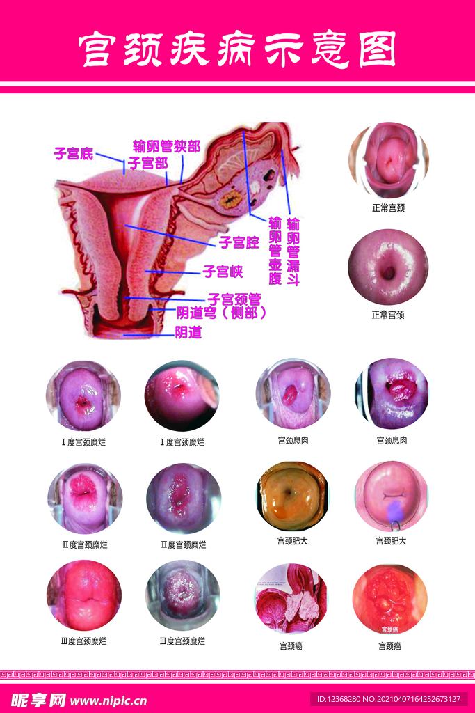 宫颈示意图