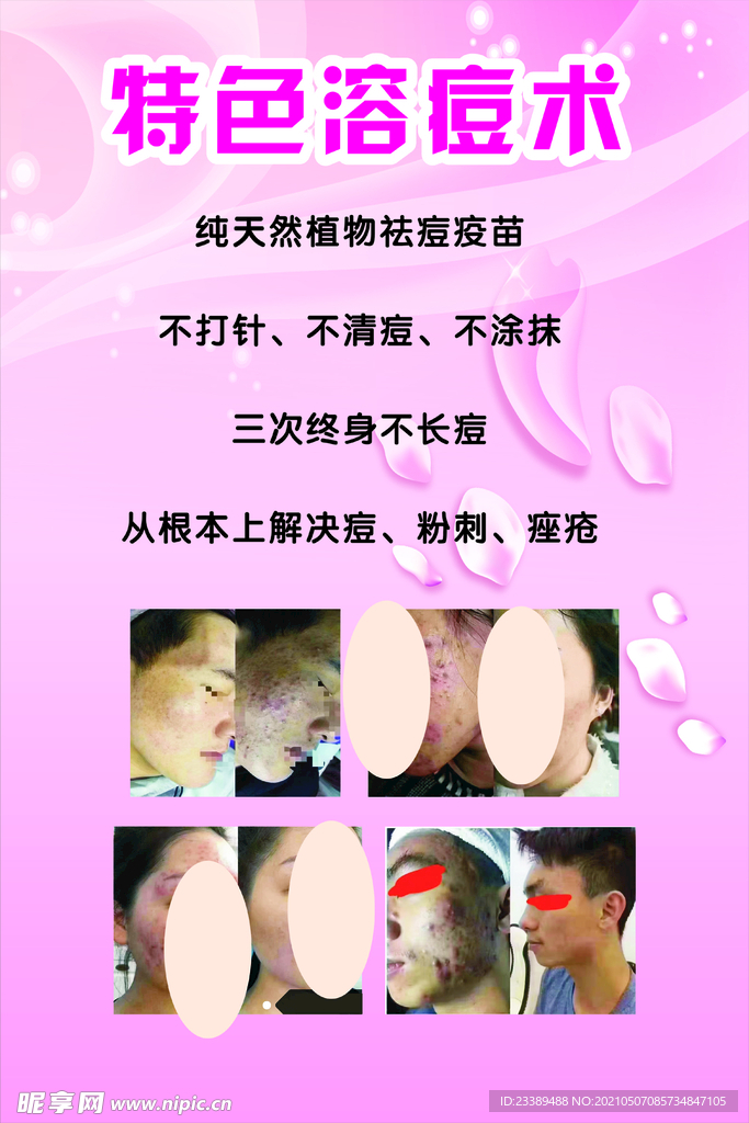 面部美容特色溶痘术