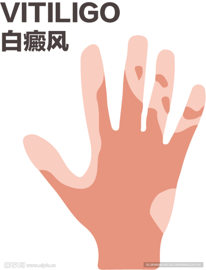 白癜风手部