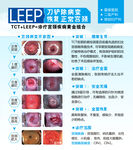 TCT和利普刀LEEP技术宣传