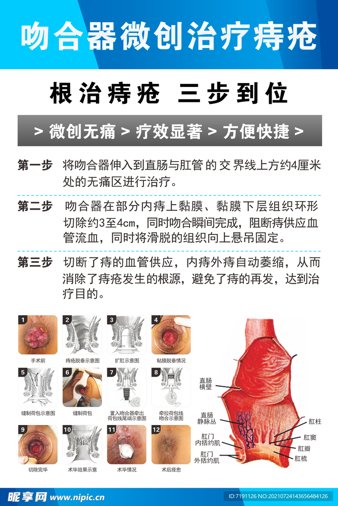 吻合器微创治疗痔疮