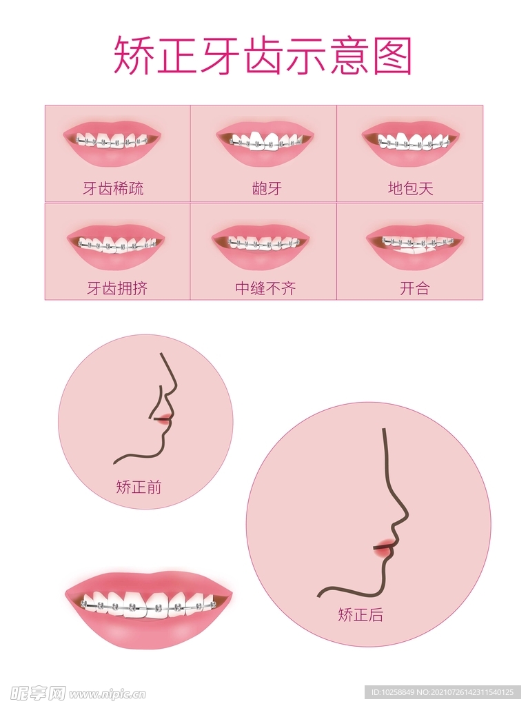 牙齿矫正示意图