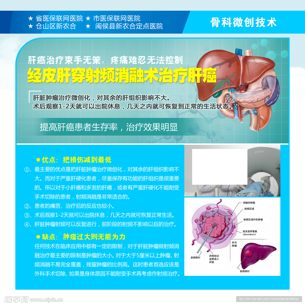 经皮肝穿刺射频消融术治疗肝癌