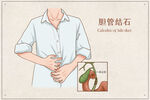 胆管结石