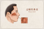 过敏性鼻炎