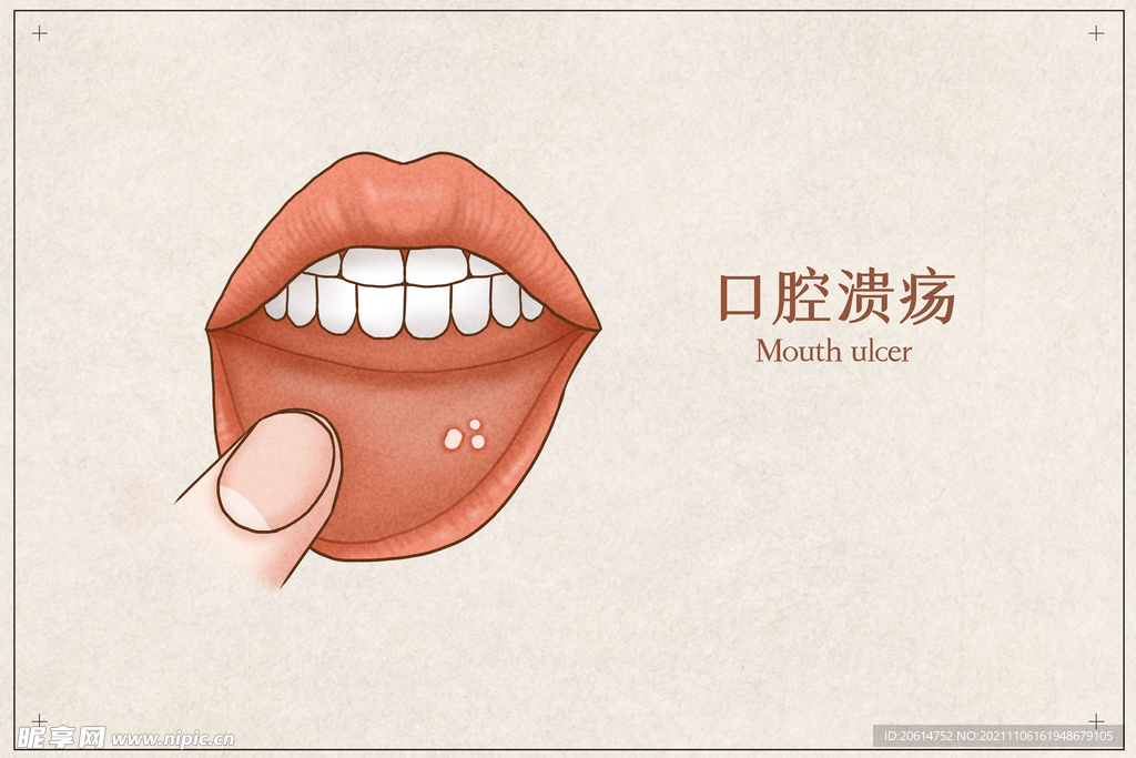口腔溃疡