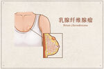 乳腺纤维腺瘤