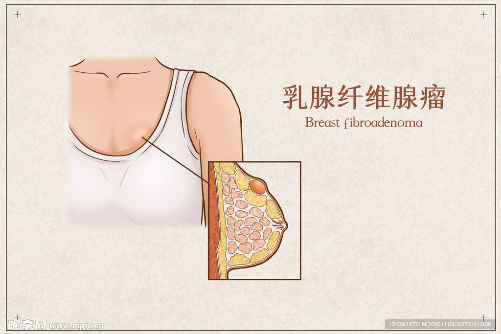 乳腺纤维腺瘤